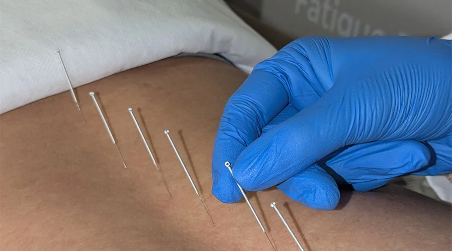 clinical-acupuncture
